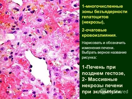 Некроз печени
