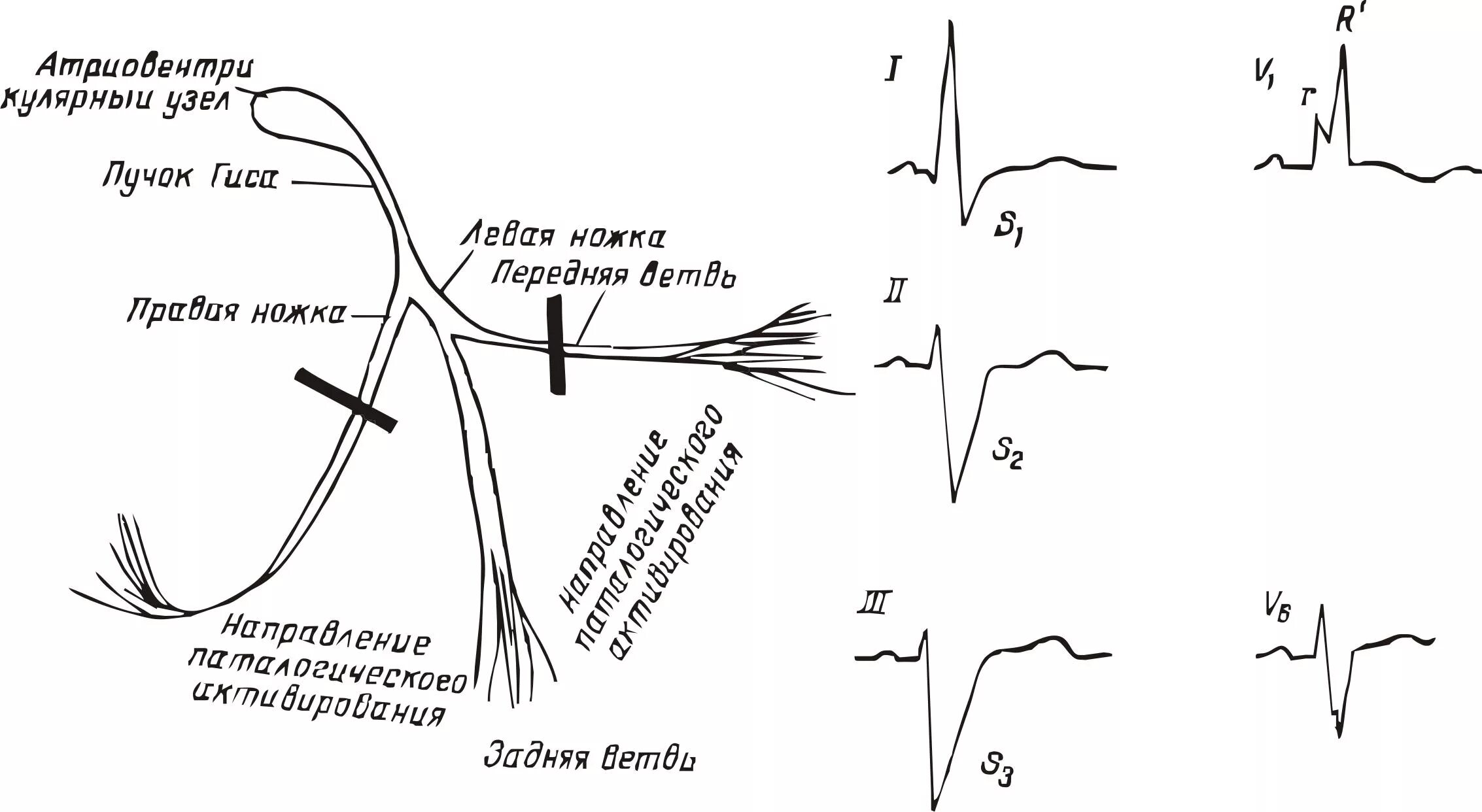 Левая ножка п гиса. Блокада правой ножки пучка Гиса и задней ветви левой ножки пучка. Блокада ПНПГ И передней ветви ЛНПГ на ЭКГ. Блокада передней ножки левой на ЭКГ. Блокада левой задней ножки пучка Гиса.