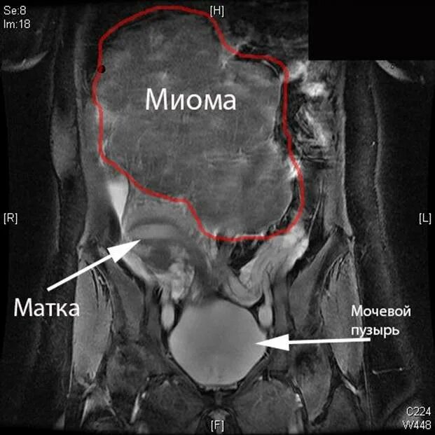 Миома матки кт контрастирование. Магнитно резонансная томография миомы матки. Миома на задней стенке матки