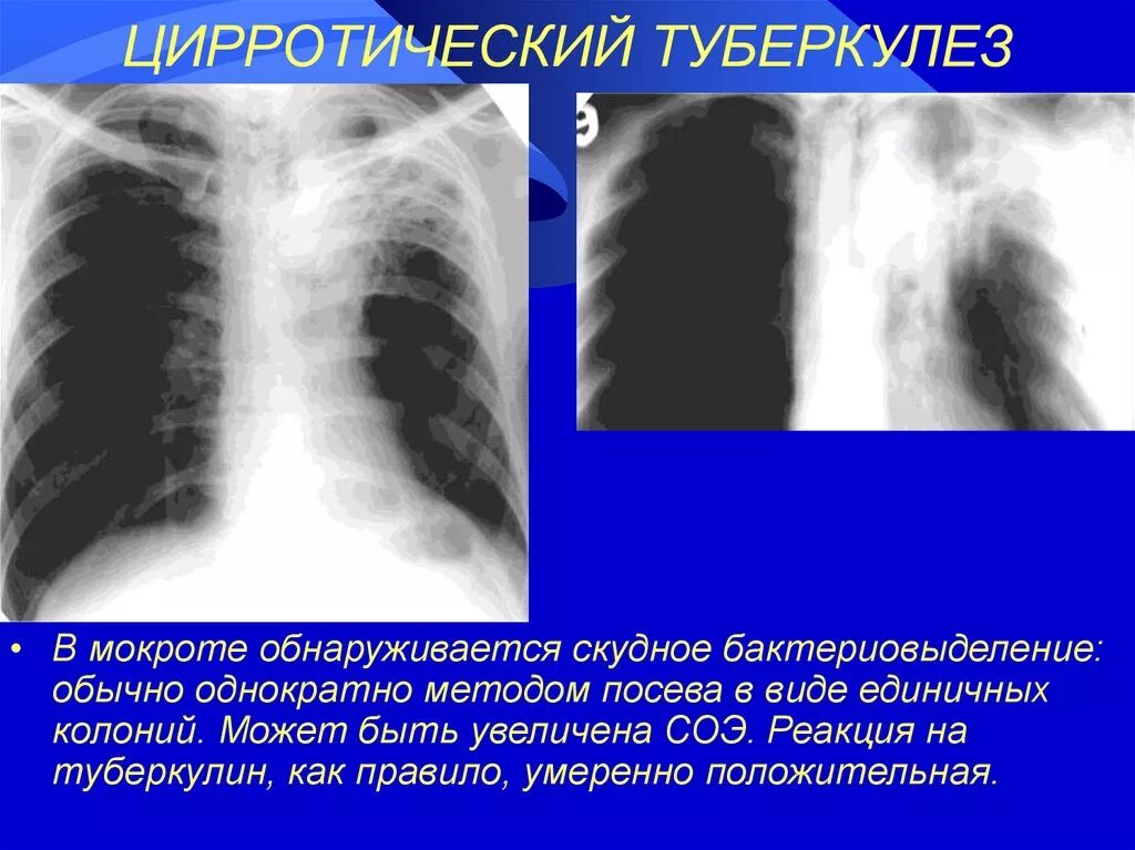 Какого цвета мокрота при туберкулезе