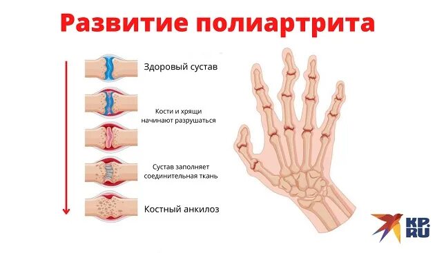 Лечение артрита пальцев народными средствами. Ревматоидный полиартрит. Симметричный полиартрит.