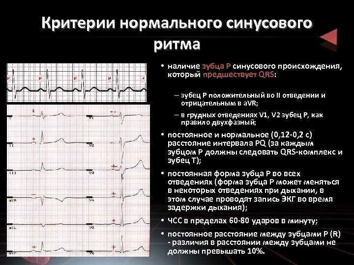 Как измерить частоту сердечных. ЭКГ расшифровка синусовый ритм. Кардиограмма сердца синусовый ритм норма. Норма ЭКГ синусный ритм. Отрицательный зубец р после QRS комплекса.