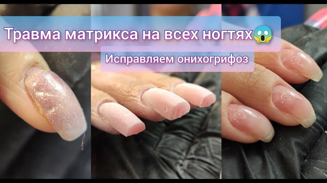 Как лечить матрикс. Поврежденный матрикс ногтя. ноготь после повреждения матрикса. поврежден ногтевой матрикс. если поврежден матрикс на ногте.