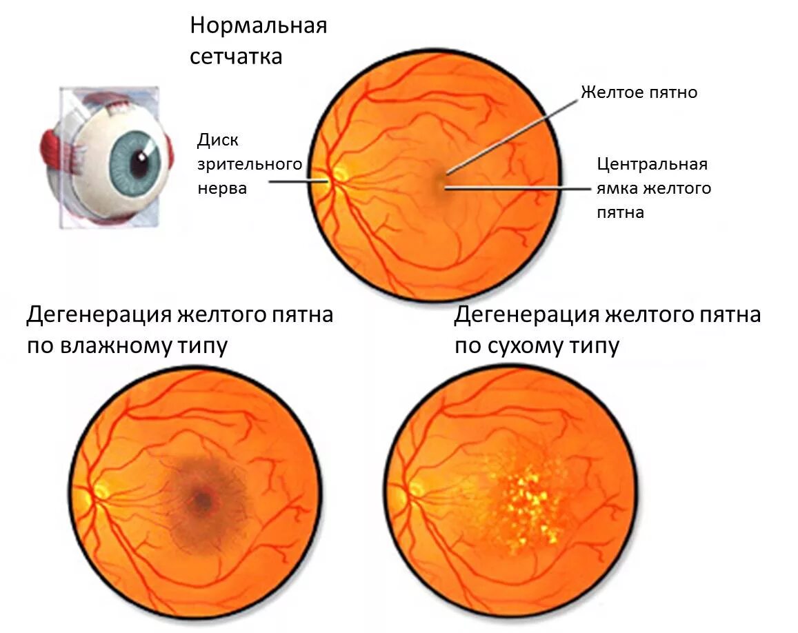 Желтое пятно. Микрокистозная дистрофия сетчатки. Макула дистрофия сетчатки глаза. Дегенерация желтого пятна (макулодистрофия). Дистрофии сетчатки офтальмология.
