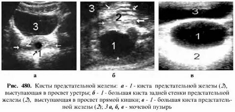 Простата 18