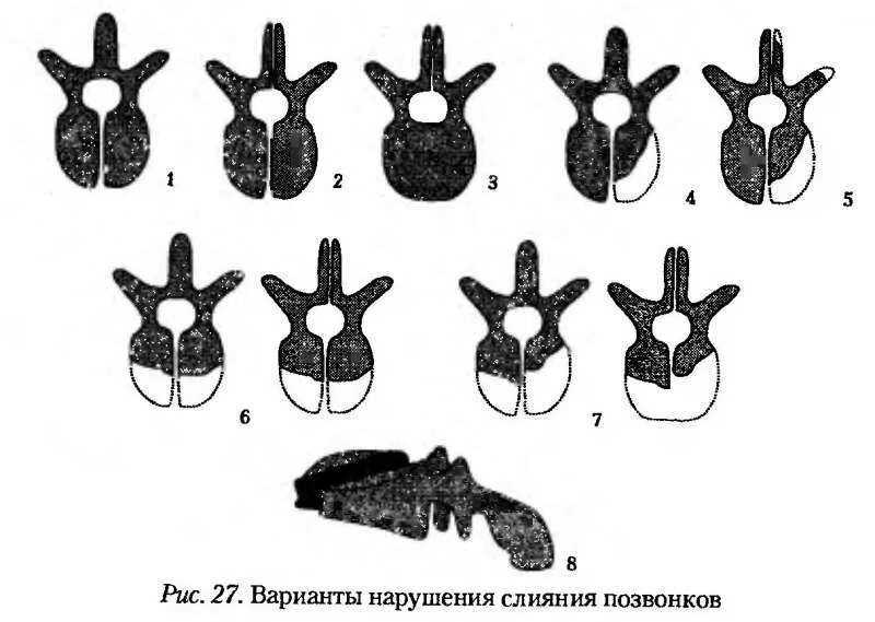 Аномалия s1 позвонка. Аномалии развития тел позвонков схема. Незаращение дужки s1 позвонка схема. Аномалии развития позвонков рентген.