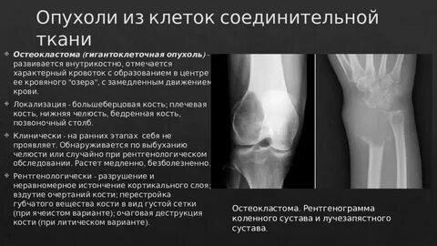 Отек кости