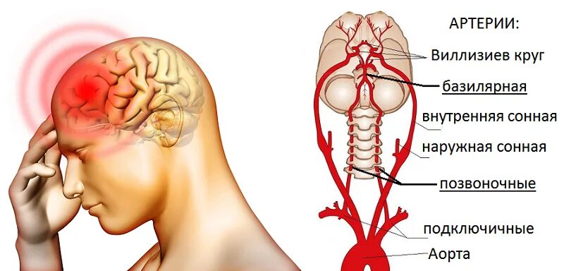 Артерии головного мозга симптомы. Сдавление позвоночной артерии. Брахиоцефальные артерии анатомия. Базилярная артерия аневризма. Левая Сонная артерия кровоснабжает.