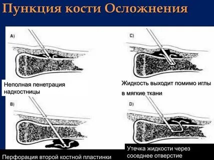 Предстательная железа пункция