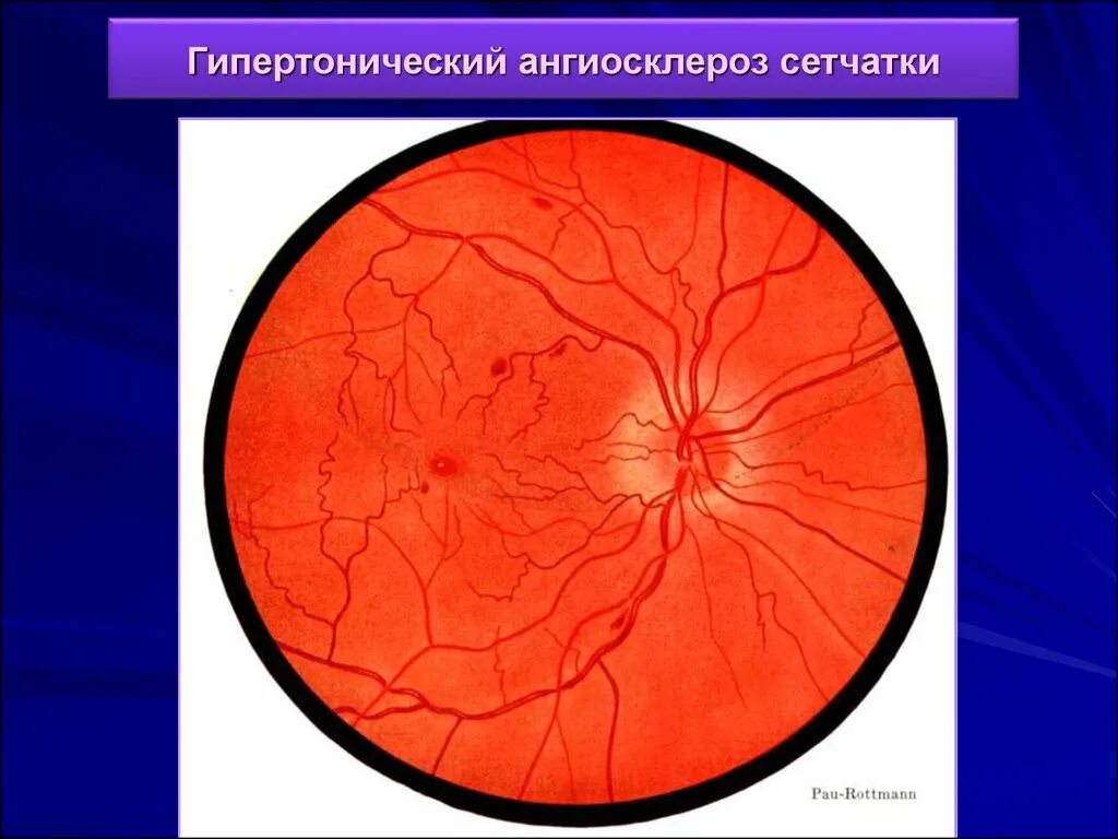 Ангиосклероз сетчатки. Ангиопатия сетчатки глаза ou что это. Гипертензивная ангиопатия сетчатки. Факосклероз ангиопатия сетчатки глаз. Сетчатки по гипертоническому типу