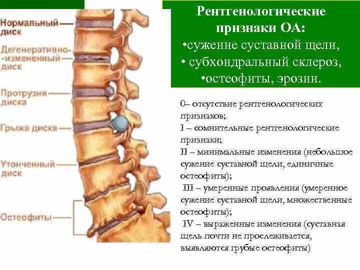 Склероз дугоотросчатых суставов поясничного отдела. Субхондральный отдел позвонка. Субхондральный склероз тел позвонков поясничного. Остеофиты по передним поверхностям тел позвонков.