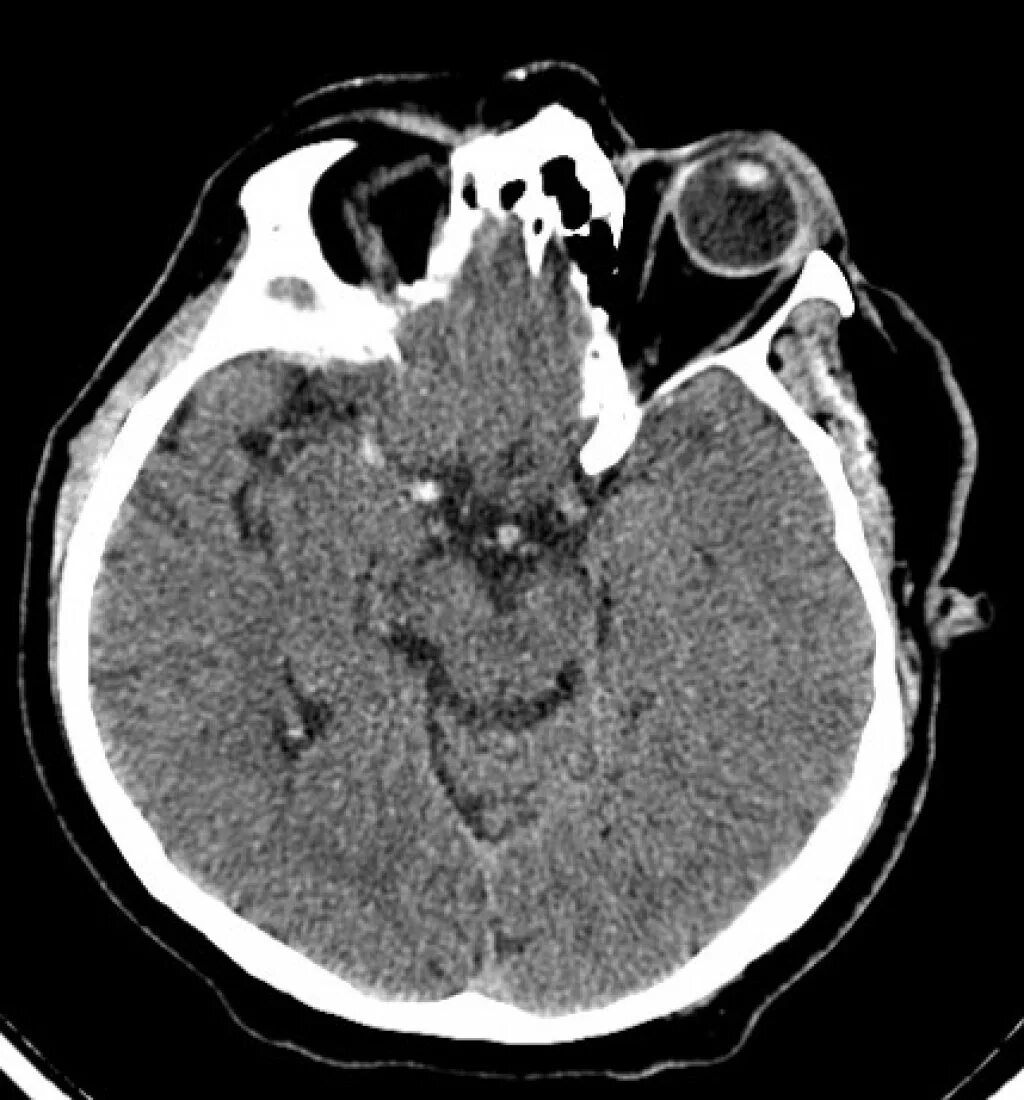 Сма мозга. Тромбоз СМА на кт. Гирерденсная среднемозговая артерия на кт. Гиперденсивный очаг на кт. Тромбоз средней мозговой артерии кт.