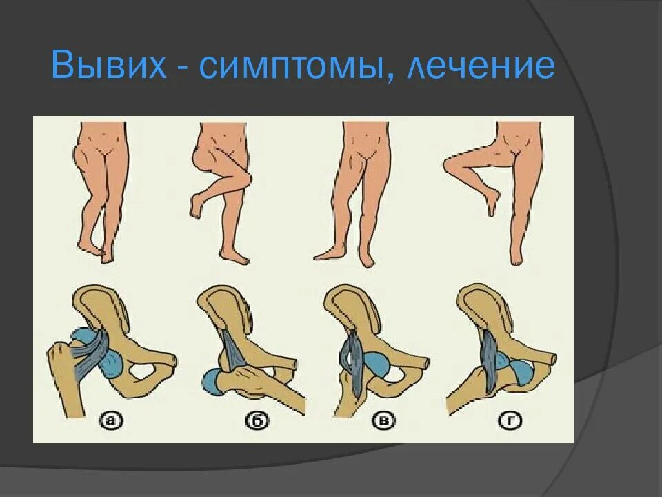 Вывих определение. Характерные признаки вывиха. вывихи понятие особенности.
