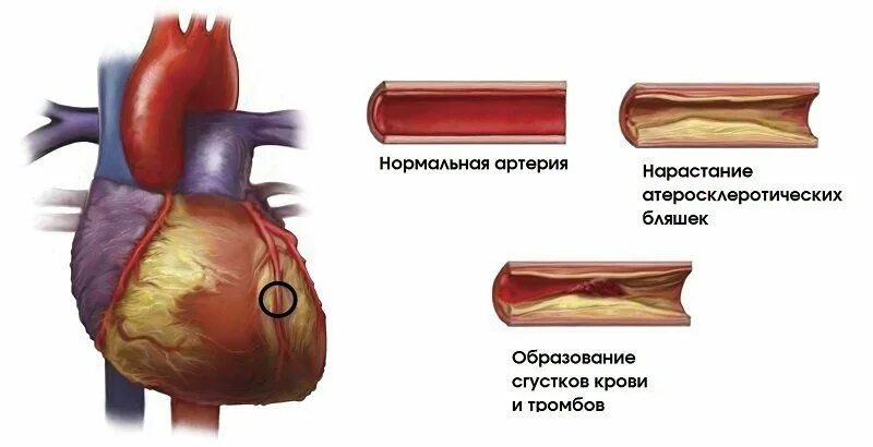 Атеросклероз коронарных артерий схема. Атеросклеротическое поражение коронарных артерий. Атеросклероз венечных артерий сердца. Нестенозирующий атеросклероз коронарных артерий. Сердечный тромбоз