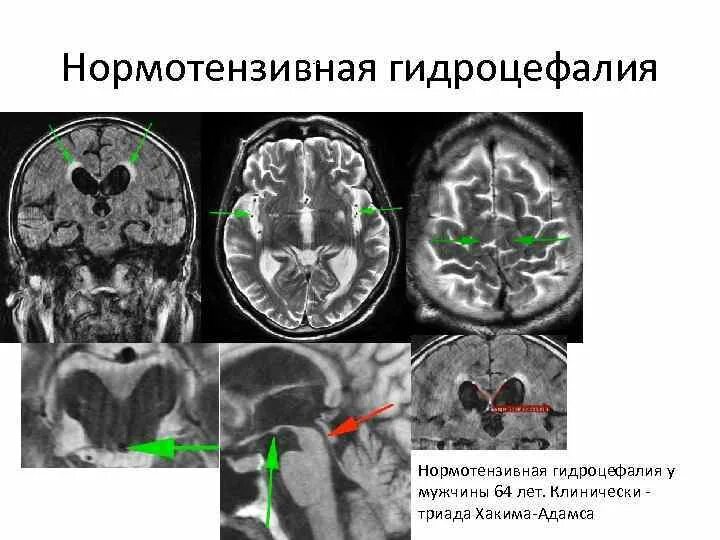 Триада Хакима Адамса нормотензивная гидроцефалия. Открытая гидроцефалия головного мозга кт. Нормотензивная гидроцефалия головного мозга мрт. Гидроцефалия головного мозга на кт.