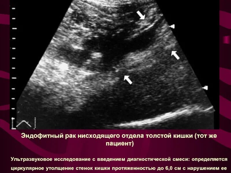 Как называется узи кишечника. Объемные образование в брюшной полости на узи. опухоль толстой кишки на узи.