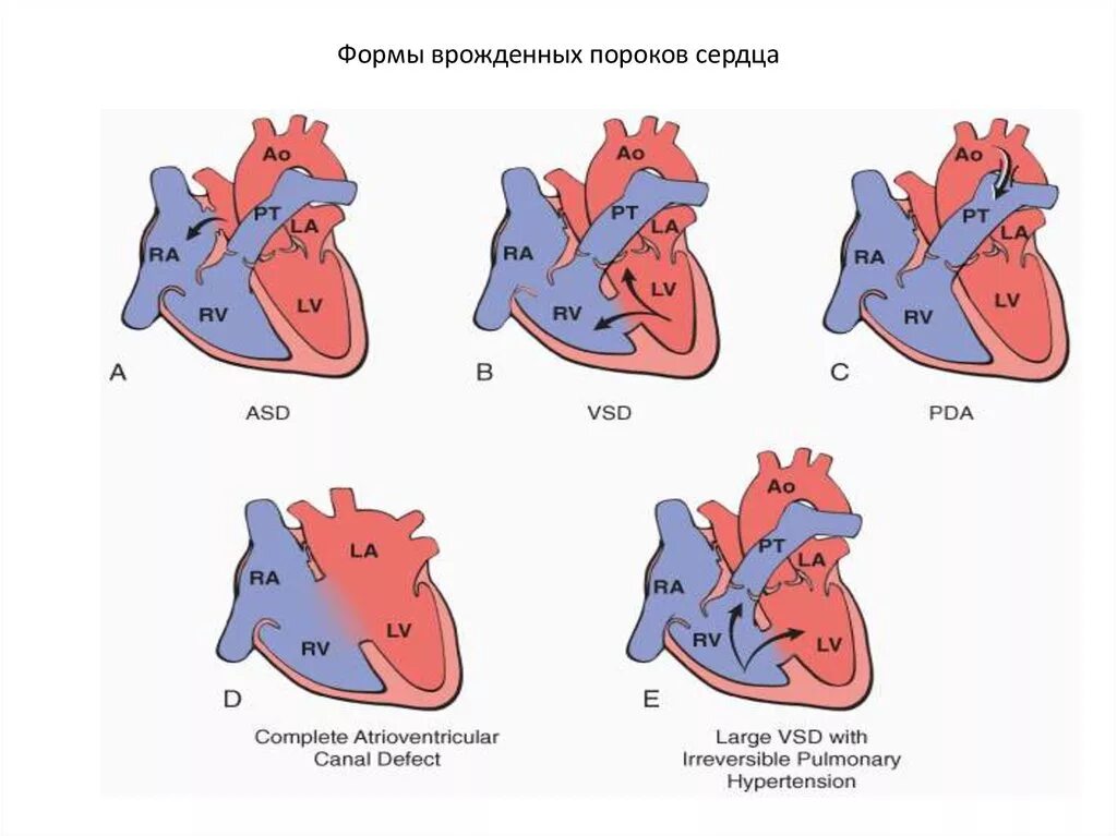 Врожденные аномалии приобретенные аномалии. Классификация врожденных пороков сердца схема. Врожденные пороки сердца патологическая анатомия. Врождённые пороки сердца классификация рисунки. Приобретенные пороки сердца схема.