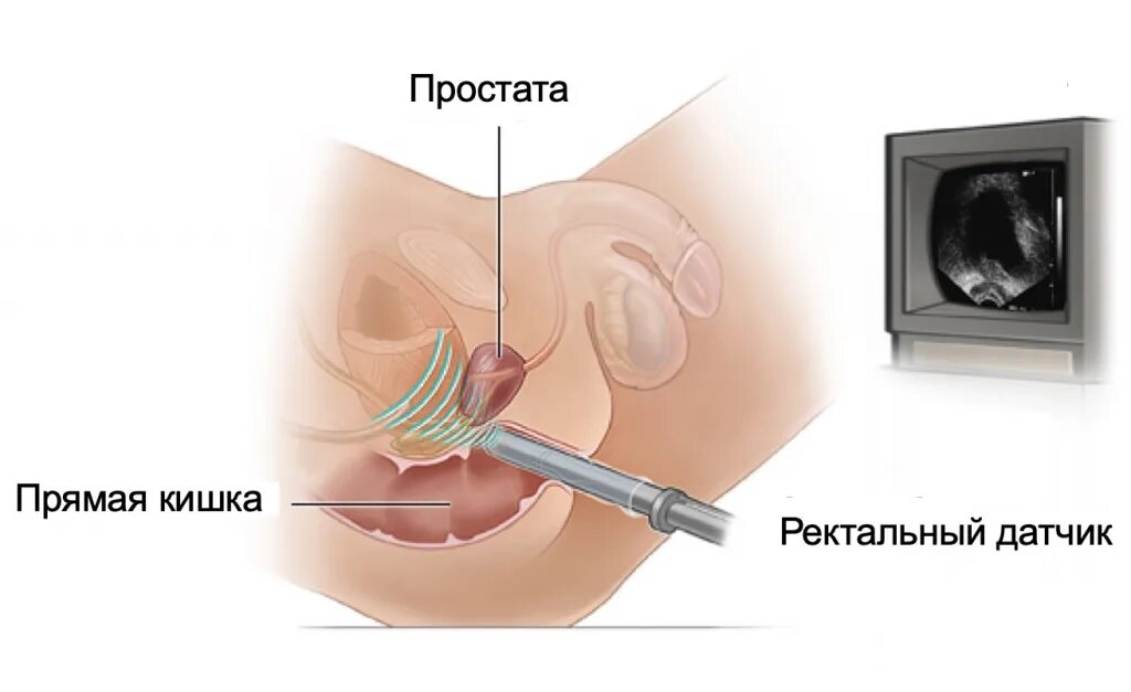 Процедура узи предстательной железы. Трансректальное узи предстательной железы. трансректальное узи малого таза. узи предстательной железы ректальным датчиком что это. трансректальное узи предстательной железы (+узи мочевого пузыря.