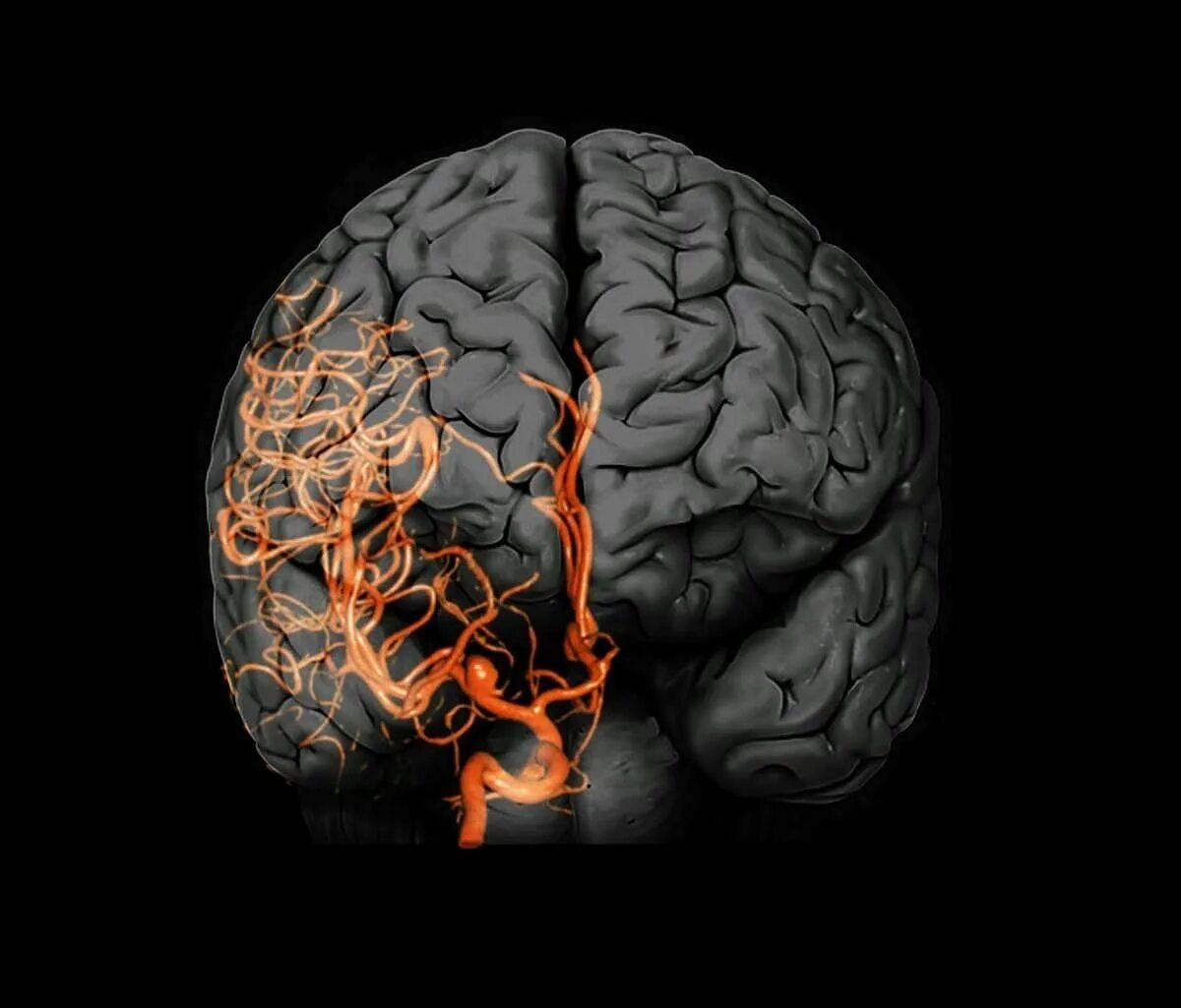 Церебральные сосуды головного мозга что это. Расширение сосудов головы