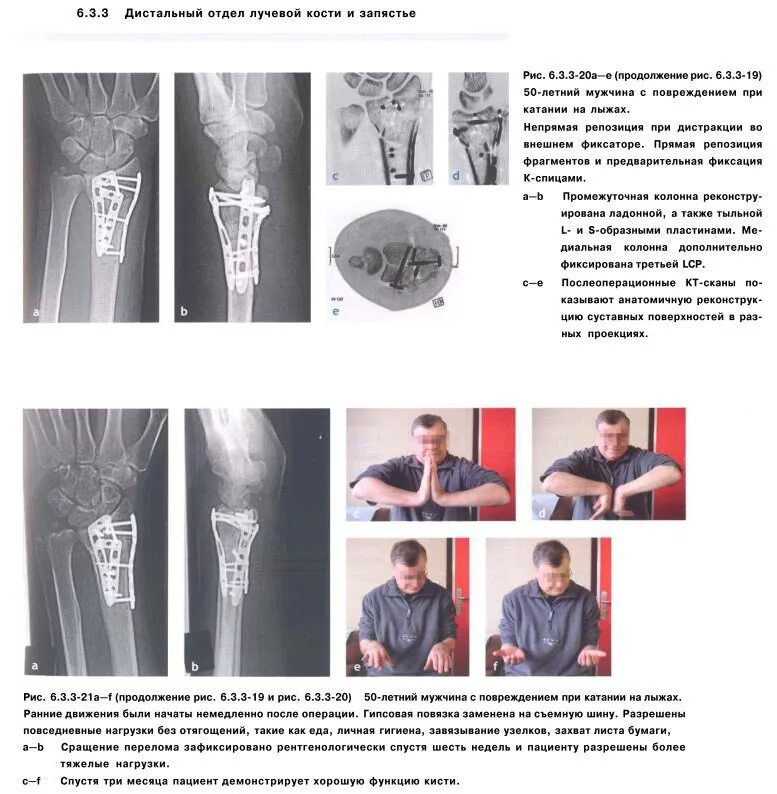 Протокол реабилитации после перелома лучевой кости. Упражнения для руки в гипсе при переломе лучевой кости. Перелом дистального отдела лучевой кости. Перелом лучевой кости со смещением гипс. Реабилитация кисти после операции