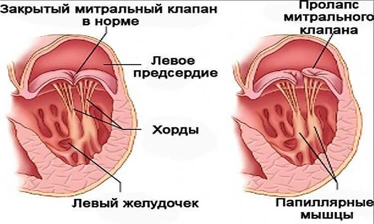 Наличие хорды у человека. Дополнительная хорда митрального клапана. Ложная хорда левого желудочка. Дополнительная хорда в сердце. Дополнительная поперечная хорда левого желудочка.