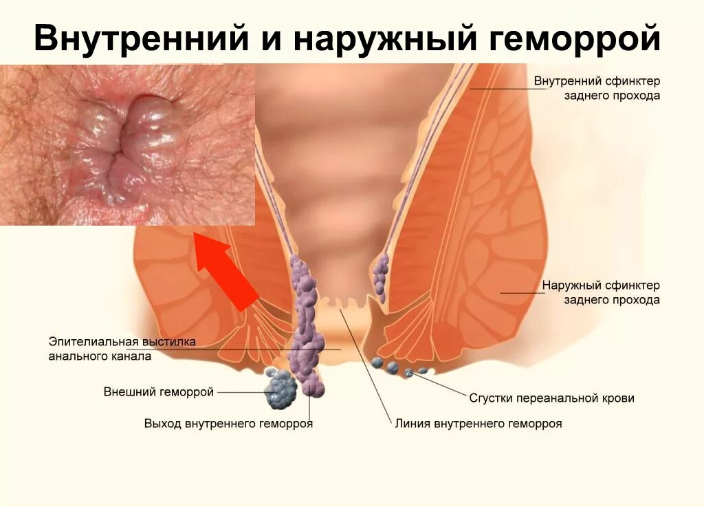 Сфинктерит прямой кишки симптомы