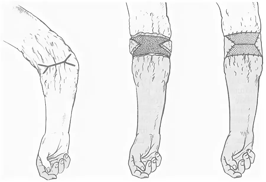 Супинационная контрактура локтевого сустава. Сгибательная контрактура локтевого сустава. Рубцовые контрактуры локтевого сустава. Сгибательная контрактура локтевого сустава степени. Сгибательная контрактура сустава