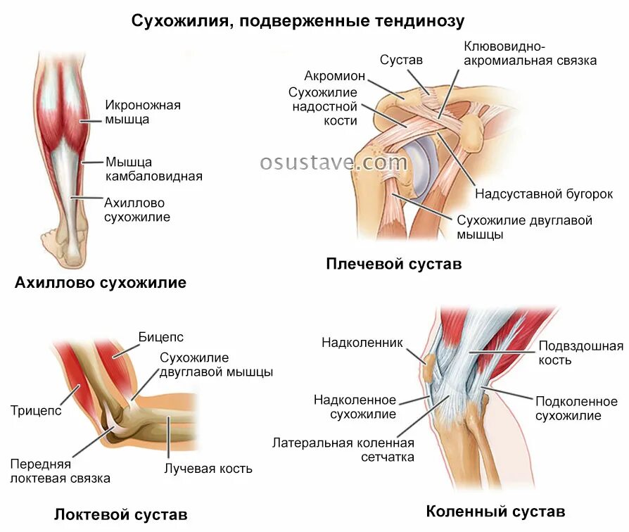 Болят сухожилия лечение