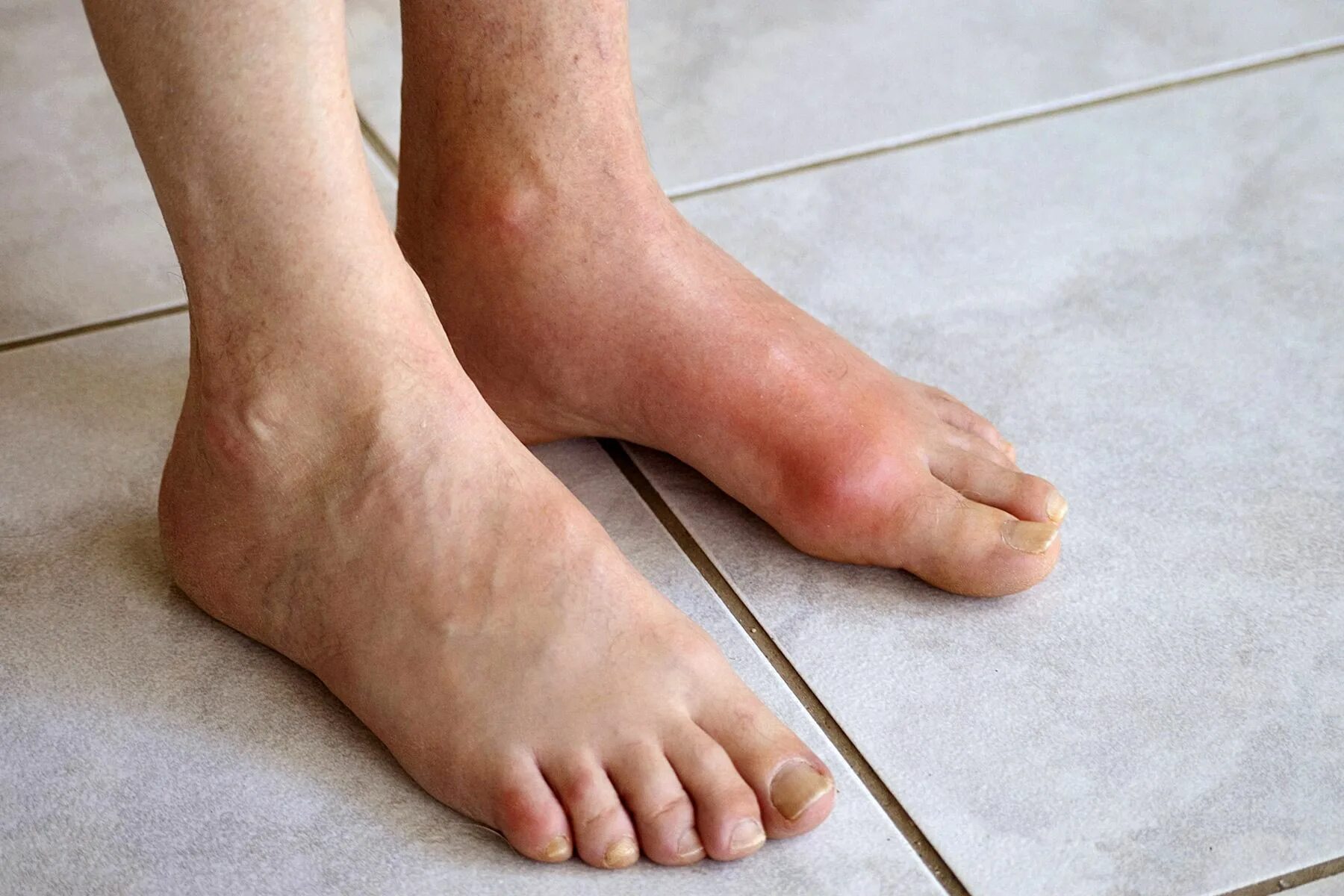 Ноги после 50. Ревматоидный артрит голеностопного. Ревматоидный артрит голеностопа. Подагра нижних конечностей. Рожистое воспаление голеностопного.