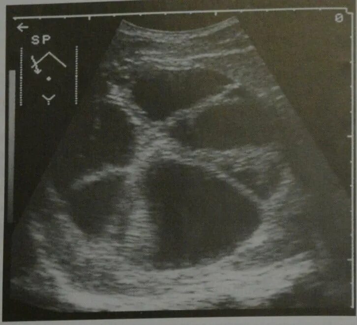 Spontaneous rupture of a large non-parasitic liver cyst: a case report Journal o