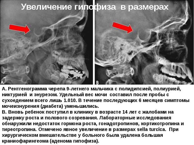 Размер гипофиза. Рентген турецкого седла опухоль гипофиза. Турецкое седло рентген описание. Аденома гипофиза рентген черепа. Опухоль турецкого седла рентген.