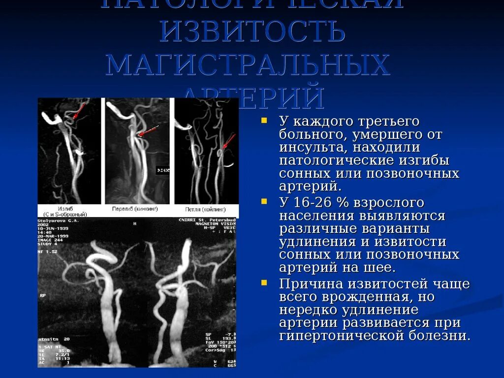 Изгиб вса. Извитость позвоночной артерии v2. Койлинг позвоночных артерий. Патологический изгиб внутренней сонной артерии. Извитость позвоночной артерии в v1.