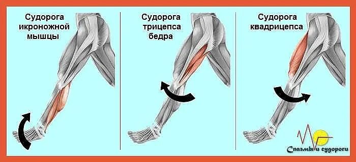 Свело икроножную мышцу. Почему сводит бедра