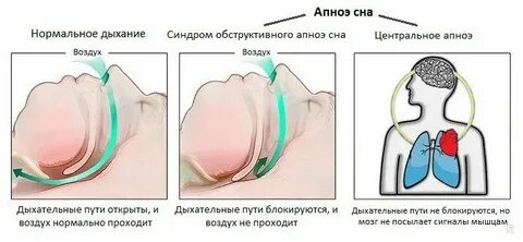Хрип во сне