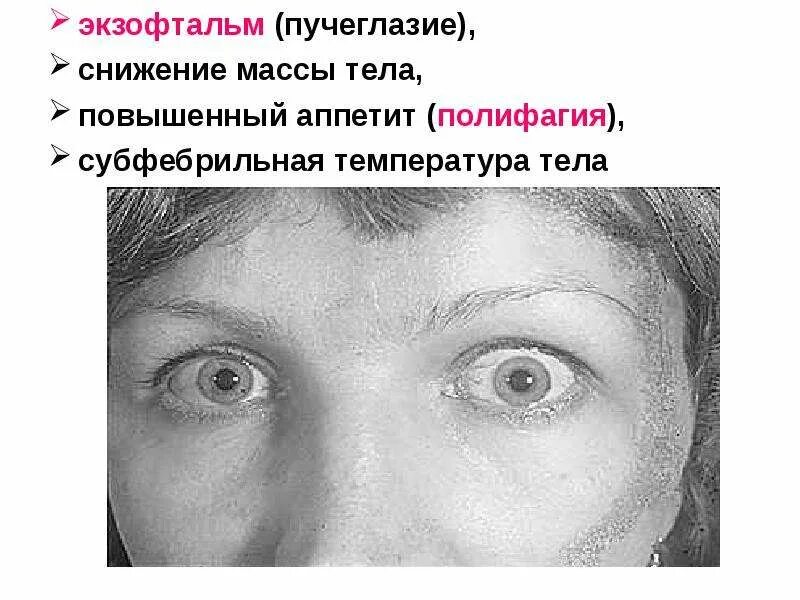 Экзофтальм наблюдается при. Презентация на тему экзофтальм. Эндокринный экзофтальм.