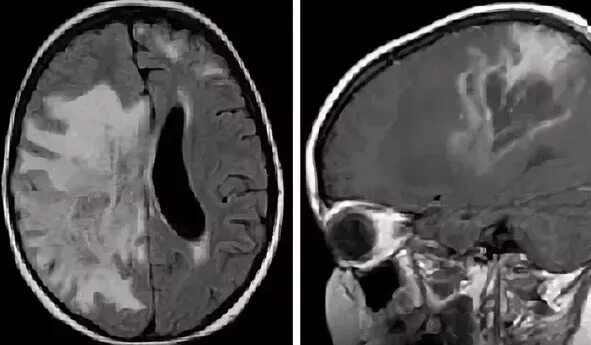 Лейкоэнцефалит. Лейкоэнцефалит ван богарта. лейкоэнцефалит шильдера. подострый склерозирующий лейкоэнцефалит ван-богарта. мрт лейкоэнцефалит ван богарта.