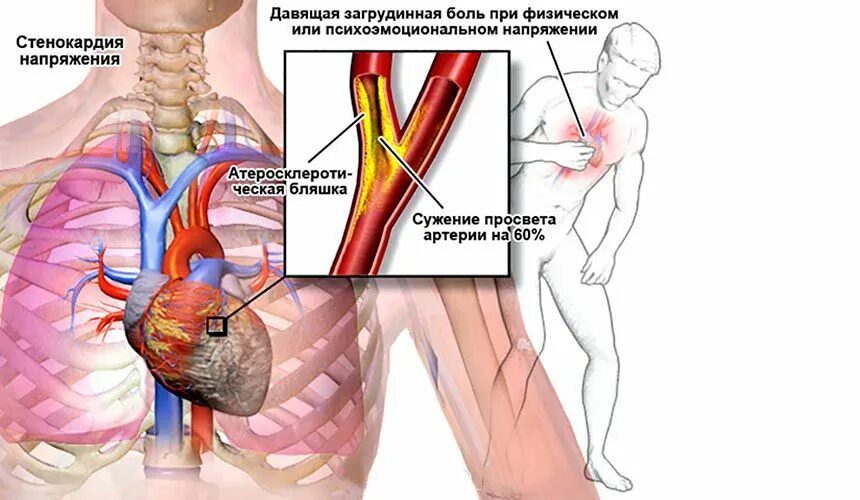 Стенокардия напряжения. Давящая загрудинная боль. Загрудинная боль стенокардии.