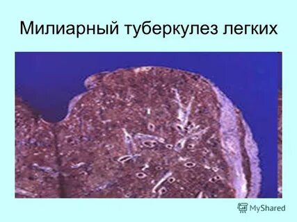 Милиарный туберкулез легких описание