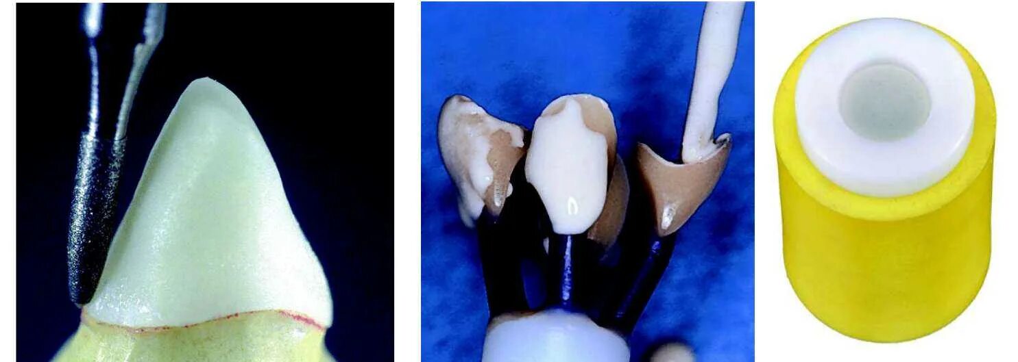 Почему не изготавливают цельнокерамических подошв. Цельнокерамическая коронка препарирование. Цельнокерамическая коронка e-Max. Цельнокерамическая препарирование зубов под цельнокерамические. Цельнокерамическая коронка Импресс.