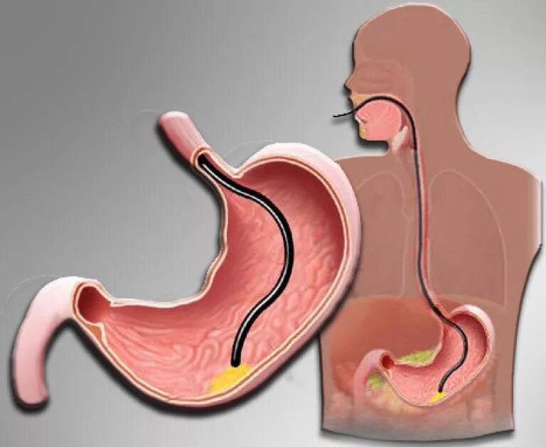 Эфгдс что это такое. Эзофагогастродуоденоскопия (ЭГДС). Трубка для обследования желудка. Эндоскопическое исследование желудка.