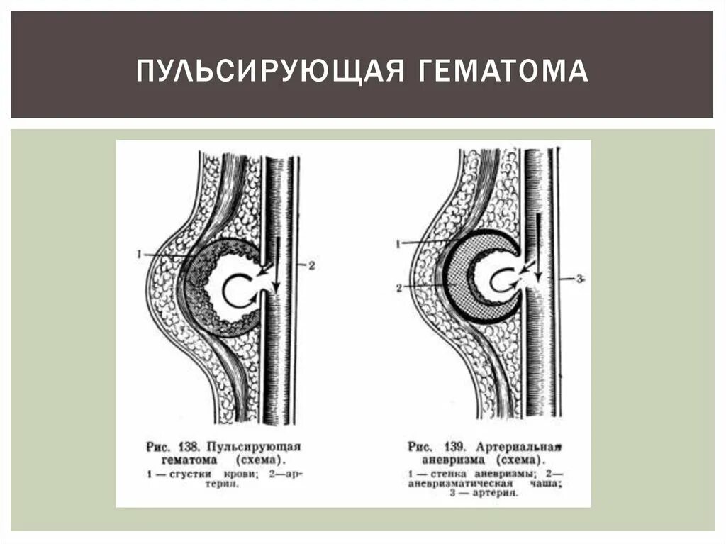 Причины появления гематомы на руке - Sammedic.ru