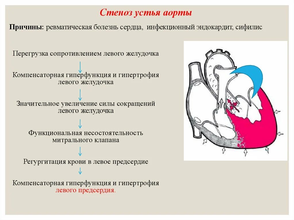 Аортальный стеноз что это такое. Стеноз устья аорты и аортальный стеноз. Стеноз устья аорты причины. Стеноз устья аорты гемодинамика. Нарушение гемодинамики при стенозе устья аорты.