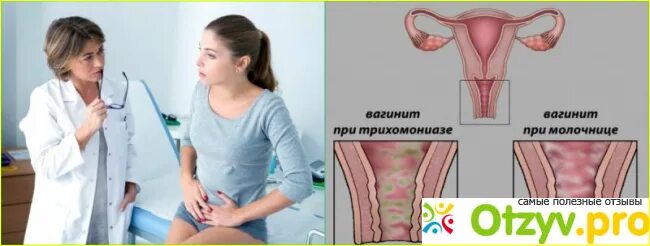 Кольпит причины симптомы у женщин. Трихомонадный вагинит. урогенитальный кандидозный кольпит.