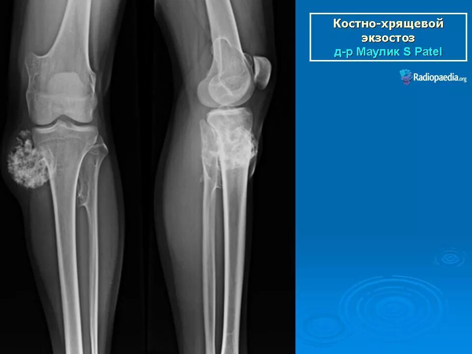 Экзостоз мкб 10. Костно-хрящевой экзостоз большеберцовой кости. костно-хрящевой экзостоз (остеохондрома).. костехрещевой экзостоз. косто эрещевой эгзастос.