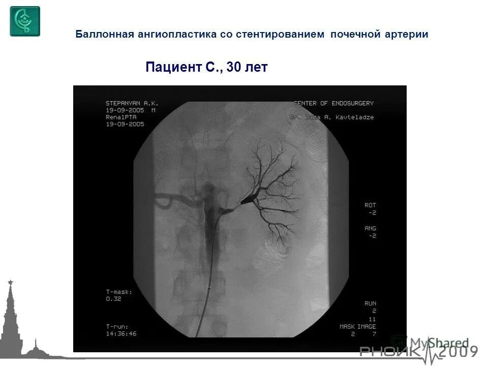 Баллонная дилатация почечной артерии. Ангиопластика почечных артерий. Стентирование почечной артерии. Стентирование почечной артерии. Операция стентирования сосудов почек.
