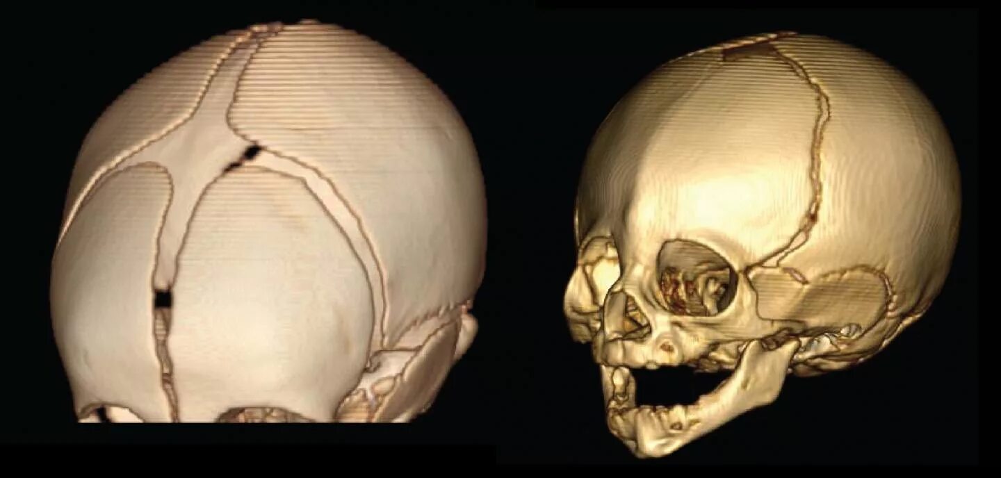 Краниостеноз башенный череп. Череп новорожденного ребенка зубы. Черепртинка. Череп малыша