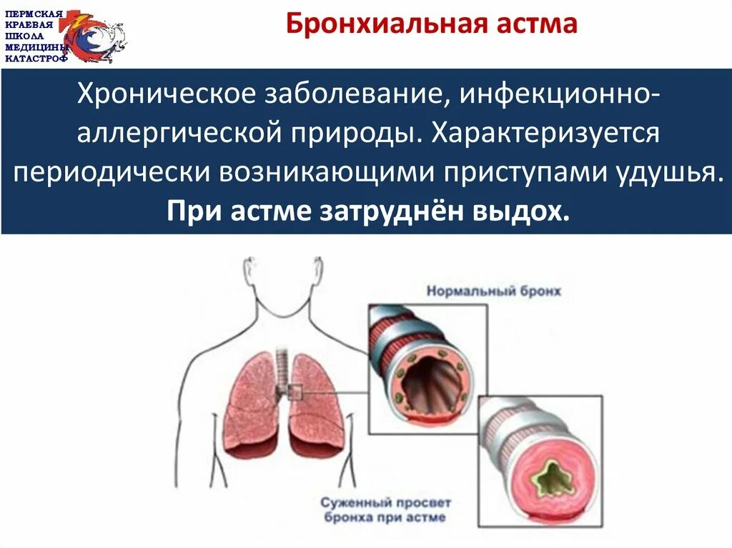 Астма заболевание дыхательных. Бронхиальная астма патология. Инфекционно зависимая форма бронхиальной астмы. Аллергические причины бронхиальной астмы. Бронхиальная астма инфекционно-аллергическая этиология.