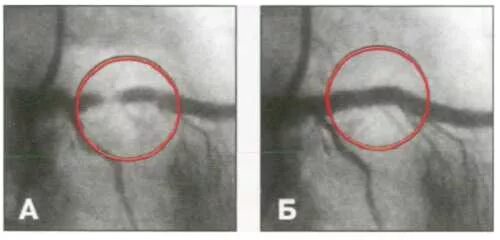 Санаторий после стентирования. Инфаркт на коронарографии. Коронарография сосудов стентирование. Коронарография при инфаркте миокарда. Коронарограмма артерии.