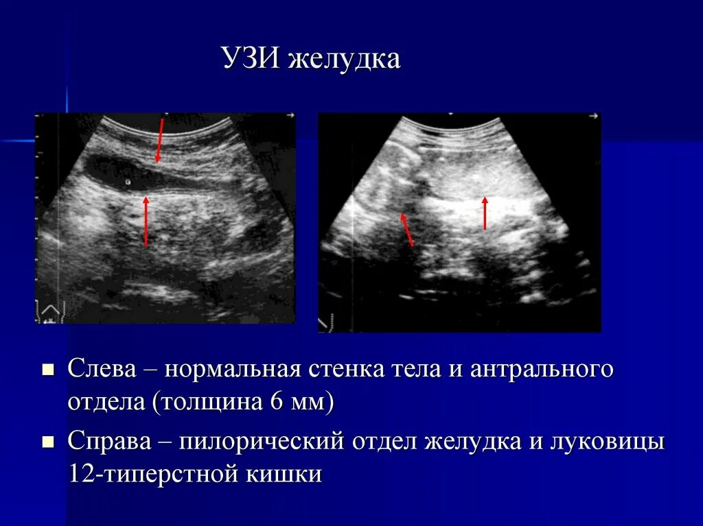 На узи виден желудок