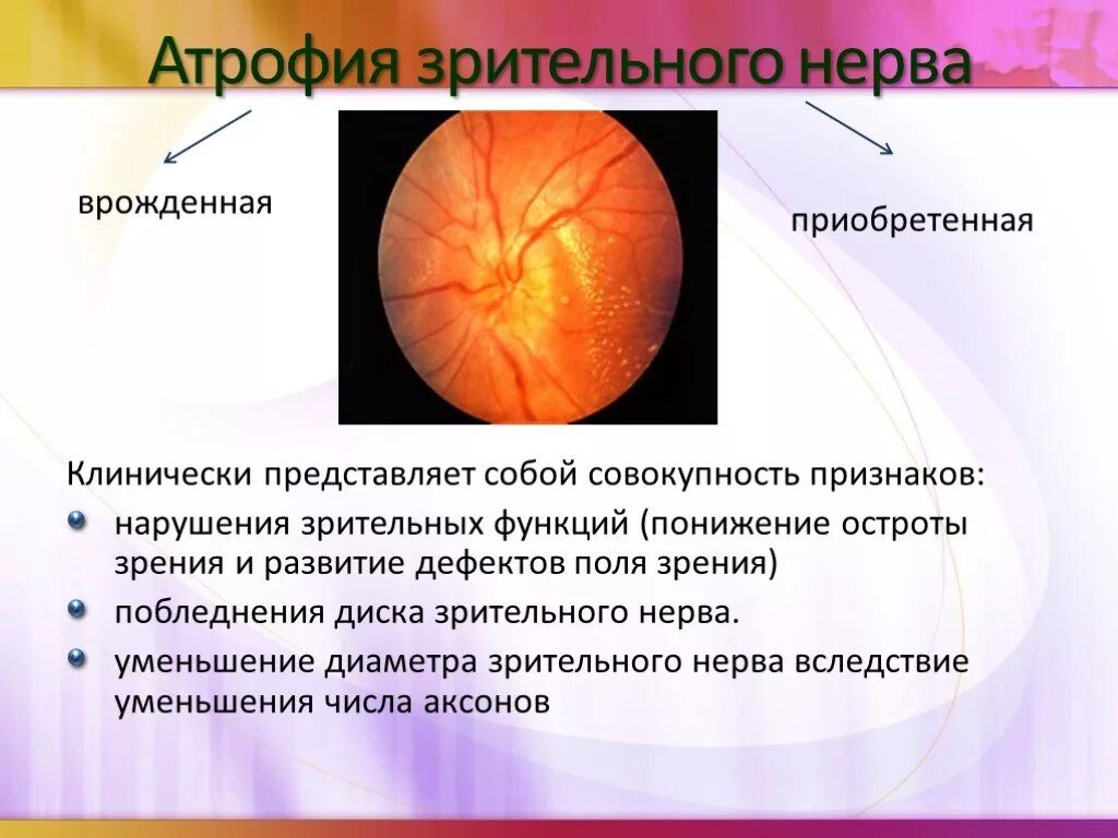 Тип зрительного нерва. Клинические признаки поражения зрительного нерва. Симптомы при атрофии зрительного нерва. Частичная атрофия зрительного нерва врожденная. Нейрооптикопатия зрительного нерва.